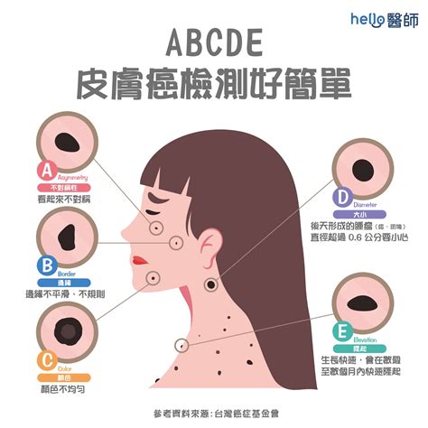 痣 有毛|痣變大、痣多或長毛會變皮膚癌？認識痣的形成與原因